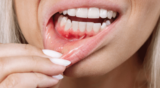 déchaussement des dents