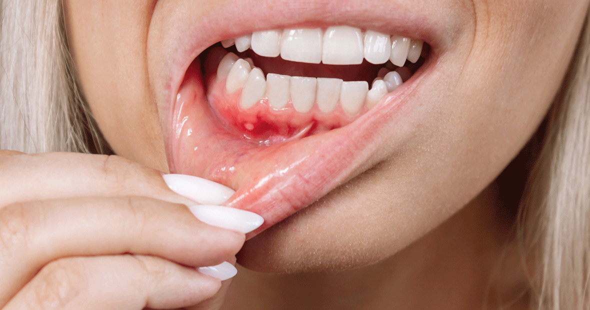 déchaussement des dents